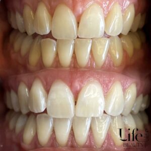 Life Beauty Salfeld - Kosmetische Zahnaufhellung - vorher - nachher